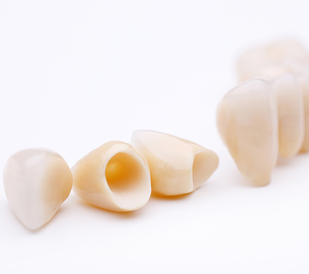 Metairie Dental Crowns and Dental Bridges