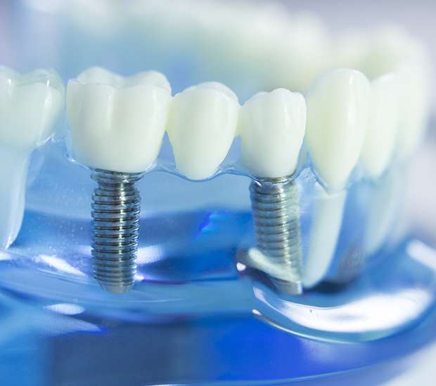 Metairie Dental Implants